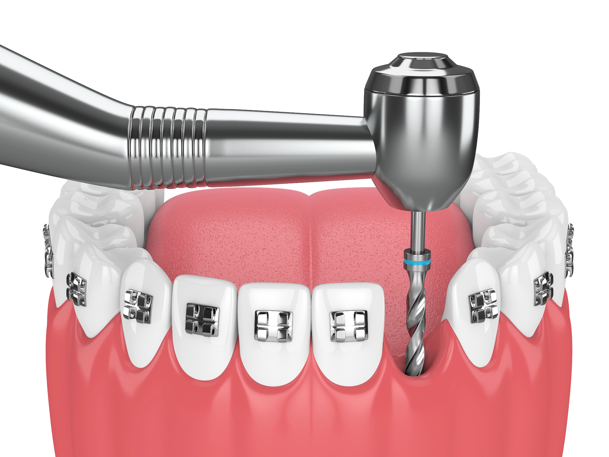 Pomembnost, ki jo endodontija ima